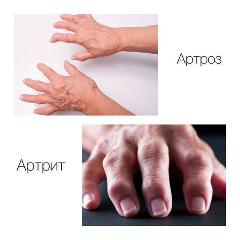 Сезонные боли в суставах рук - причины и лечение